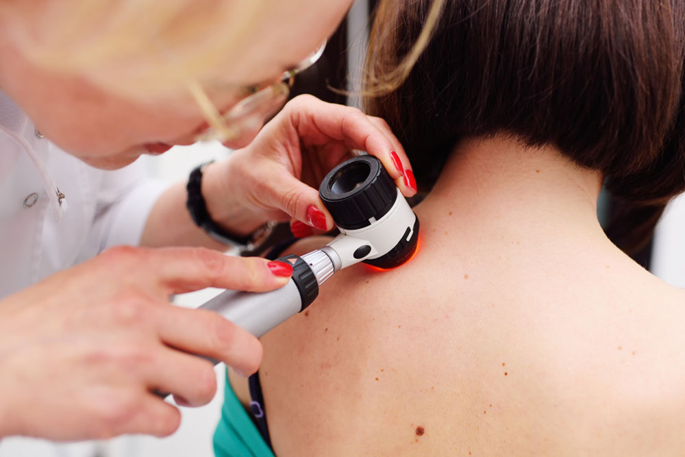 Melanoma Prevention Tips