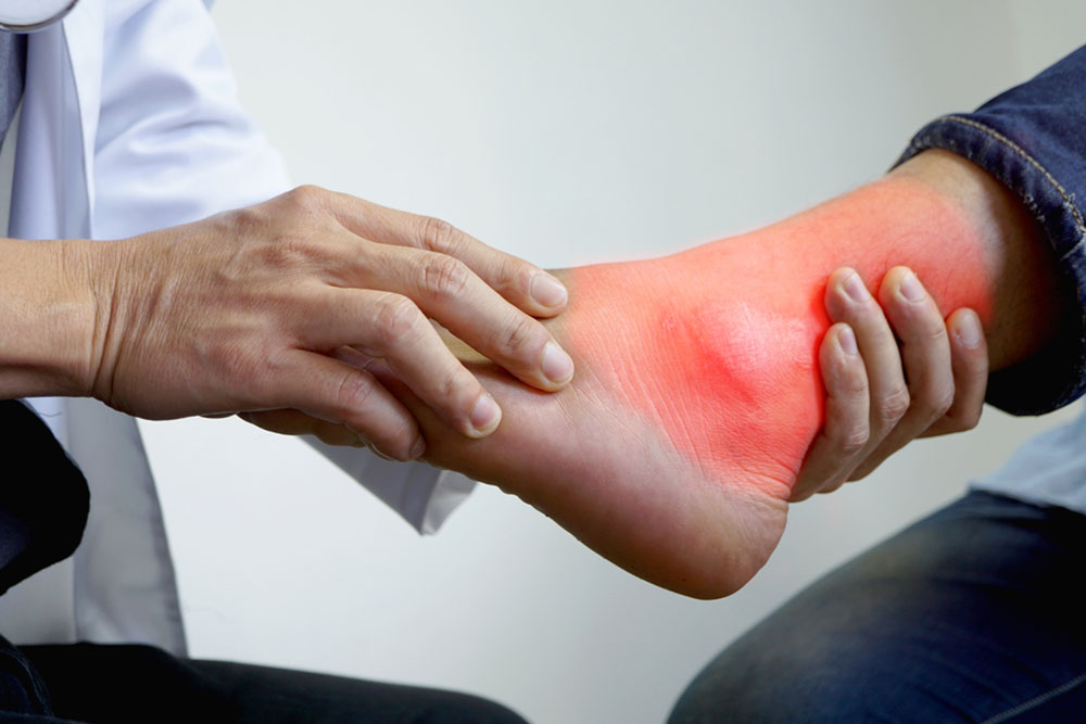 Natural Home Treatments for Gout