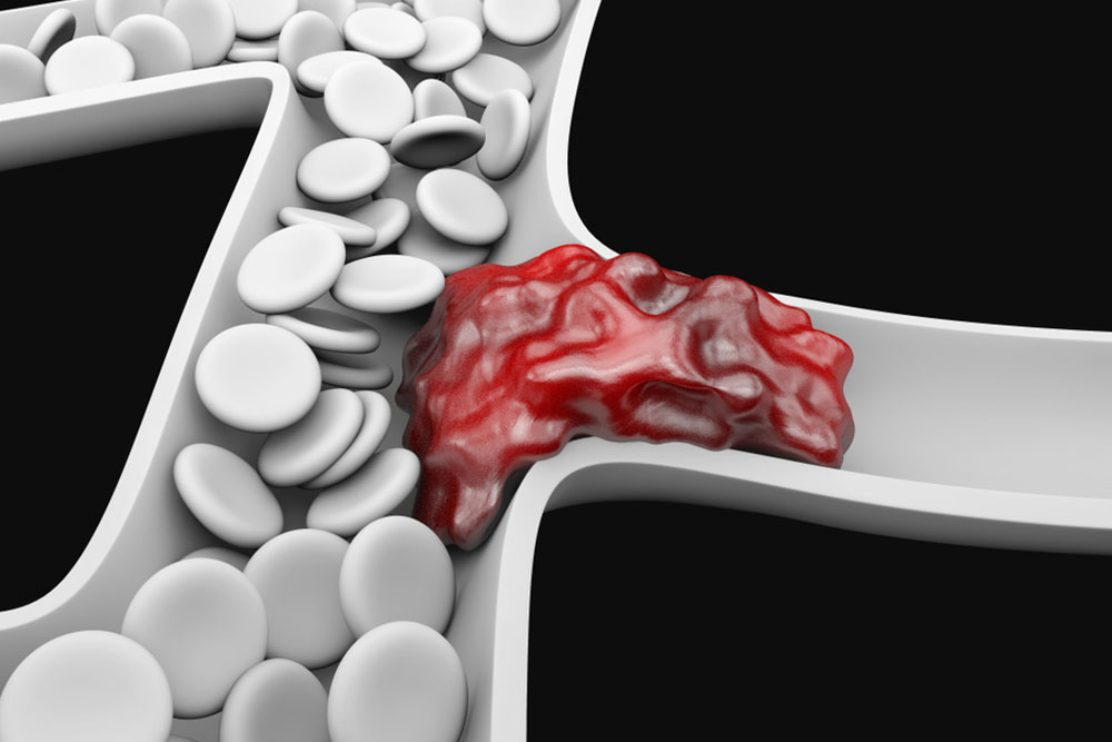 Natural Prevention for Deep Vein Thrombosis