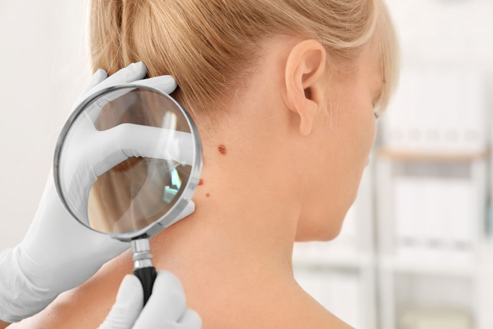 Natural Prevention for Skin Cancer