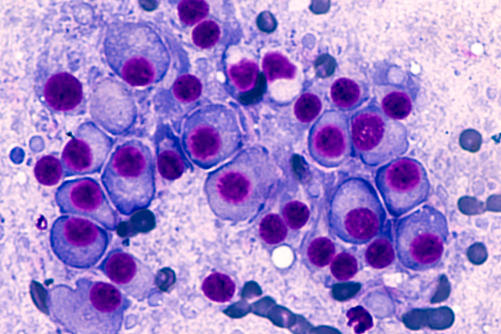 Early Warning Signs of Multiple Myeloma