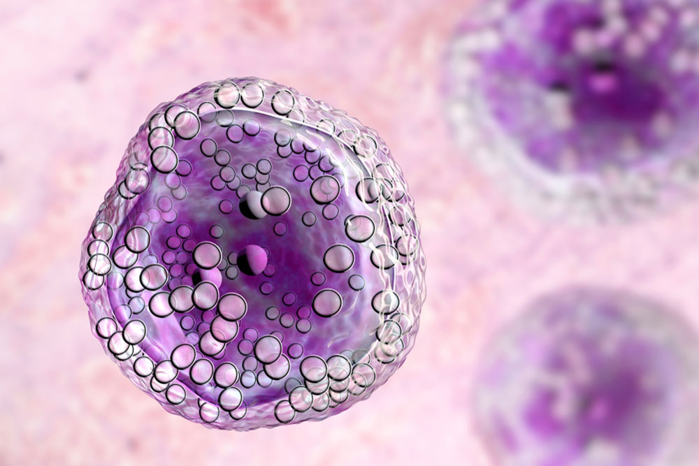 Lymphoma Warning Signs and Symptoms