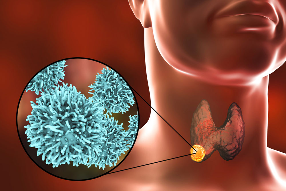 Types of Thyroid Cancer
