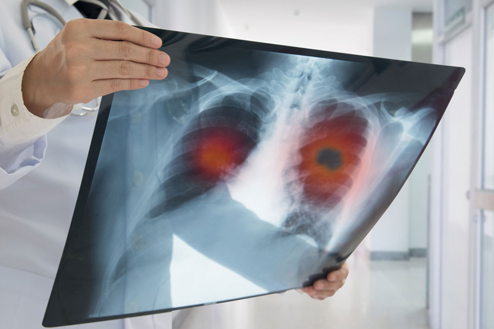 Telltale Symptoms of Lung Cancer